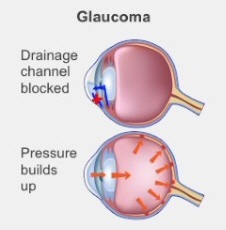 Medical illustration of a blocked drainage channel which causes pressure build up